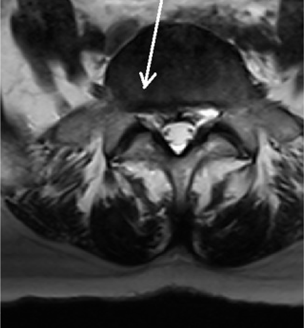 Nach SpineMED Therapie | Diskusprolaps L5/S1