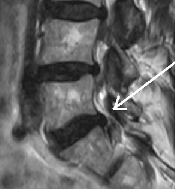 Nach SpineMED Therapie | Diskusprolaps L5/S1