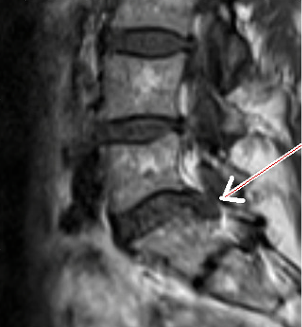 Vor SpineMED Therapie | Diskusprolaps L5/S1